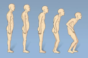 Diagrams Of Osteoporosis